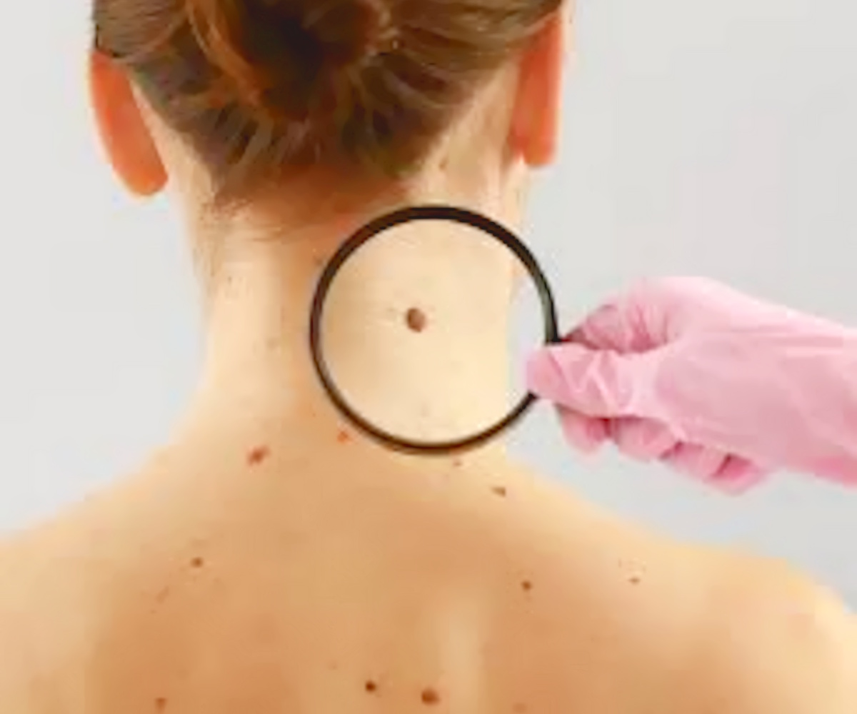 Melanoma in Italia: nel 2024 crescita dei casi e progressi nelle cure