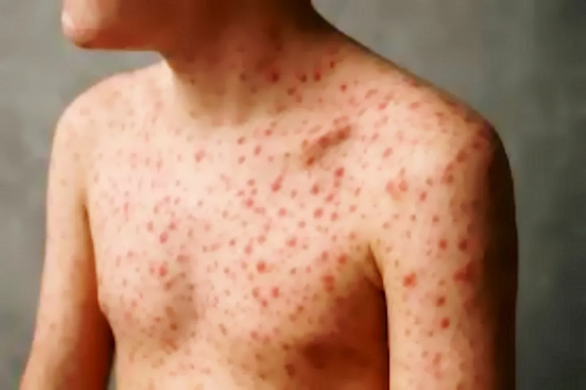 Morbillo: in calo i casi a giugno, ma l'allerta resta alta. Iss: “Fondamentale verificare il proprio stato vaccinale prima dei viaggi”